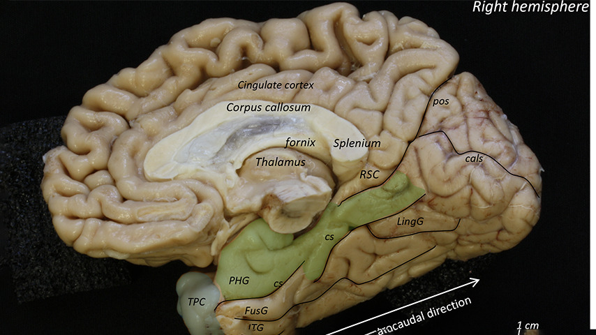 Estudio sobre Alzheimer, Ricardo Insausti