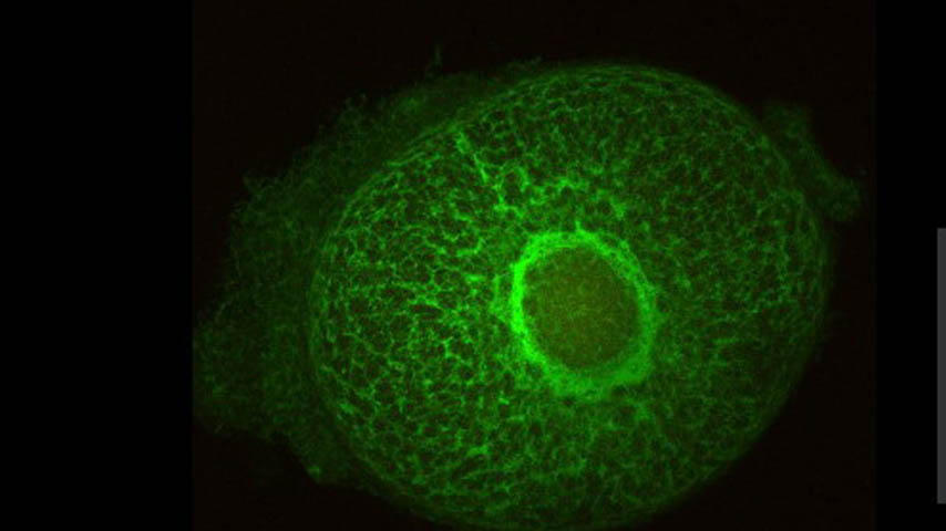 gen_glaucoma